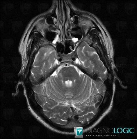 Multiple sclerosis, Brainstem, Posterior fossa, MRI