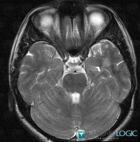 Multiple sclerosis, Cerebellar hemisphere, MRI