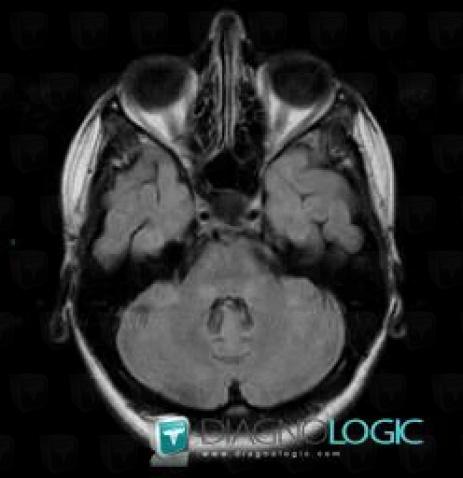 Multiple sclerosis, Cerebellar hemisphere, V4 and vermis, MRI