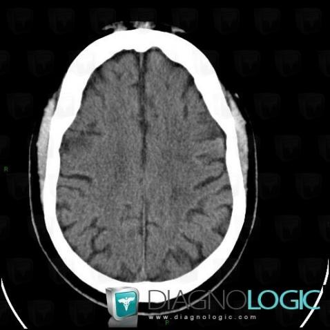 Multiple sclerosis, Cerebral hemispheres, CT