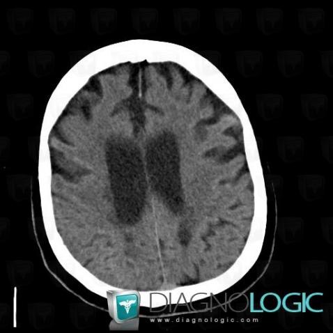 Multiple sclerosis, Cerebral hemispheres, CT