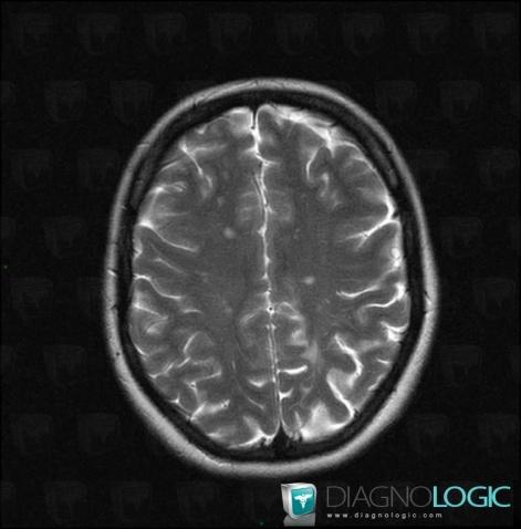 Multiple sclerosis, Cerebral hemispheres, MRI