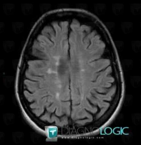 Multiple sclerosis, Cerebral hemispheres, MRI