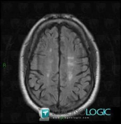 Multiple sclerosis, Cerebral hemispheres, MRI