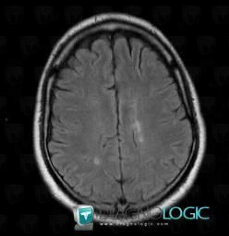 Multiple sclerosis, Cerebral hemispheres, MRI