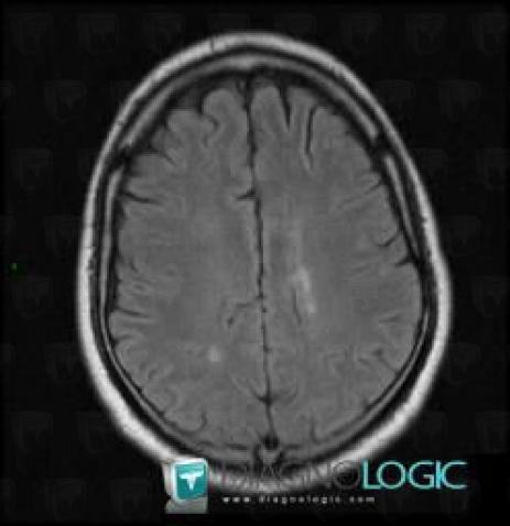 Radiology case : Multiple sclerosis (MRI) - Diagnologic