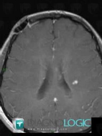 Multiple sclerosis, Cerebral hemispheres, MRI