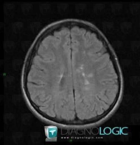 Multiple sclerosis, Cerebral hemispheres, MRI