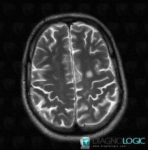 Multiple sclerosis, Cerebral hemispheres, MRI