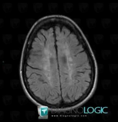 Multiple sclerosis, Cerebral hemispheres, MRI