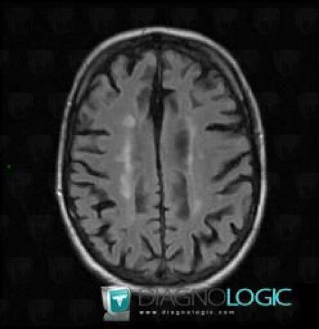 Multiple sclerosis, Cerebral hemispheres, MRI