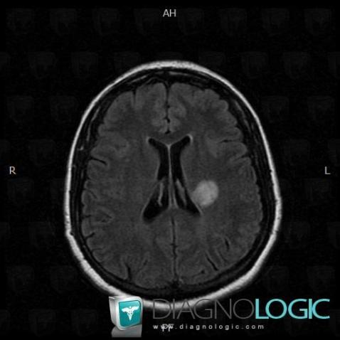 Multiple sclerosis, Cerebral hemispheres, MRI