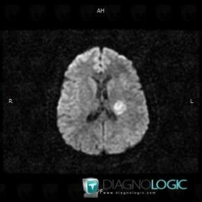 Multiple sclerosis, Cerebral hemispheres, MRI