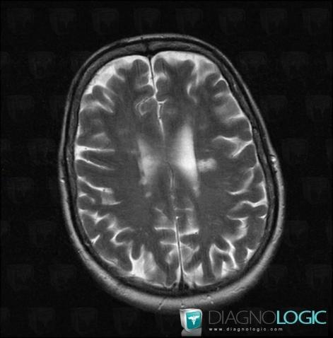 Multiple sclerosis, Cerebral hemispheres, Ventricles / Periventricular region, MRI