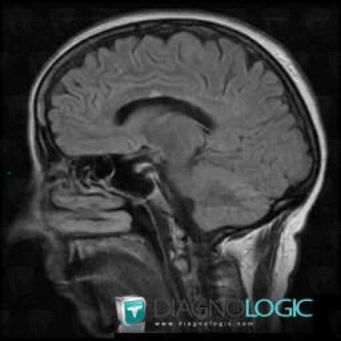 Multiple sclerosis, Corpus callosum, MRI