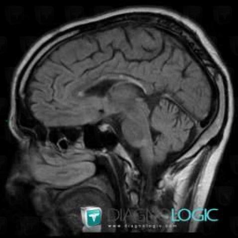 Multiple sclerosis, Corpus callosum, MRI