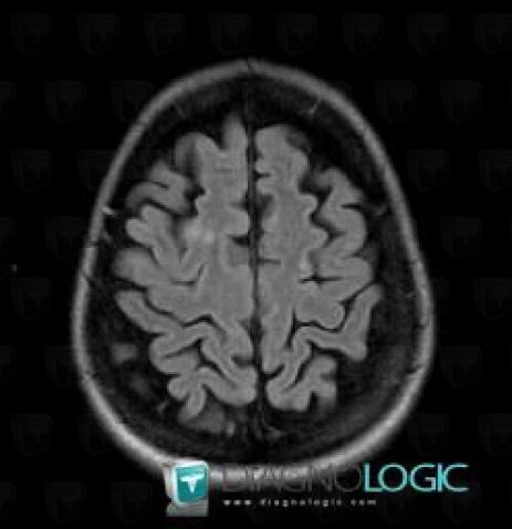 Multiple sclerosis, Cortico subcortical region, MRI
