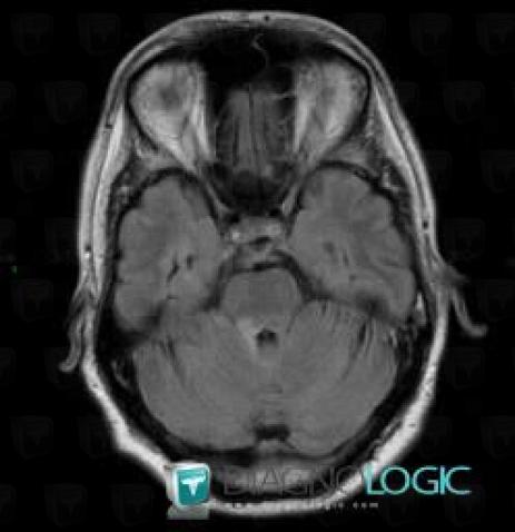 Multiple sclerosis, Posterior fossa, MRI