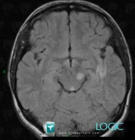 Multiple sclerosis, Posterior fossa, MRI