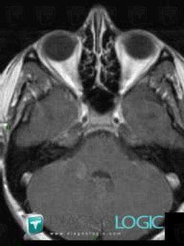 Multiple sclerosis, Posterior fossa, MRI