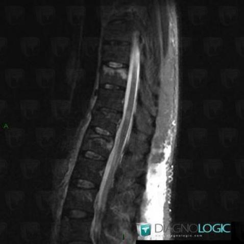 Multiple sclerosis, Spinal canal / Cord, MRI