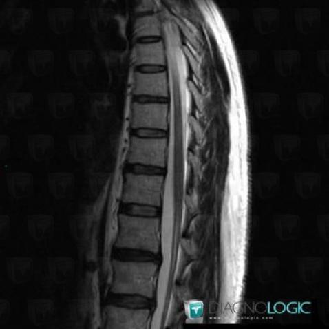 Multiple sclerosis, Spinal canal / Cord, MRI