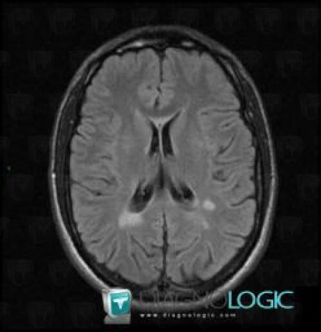 Multiple sclerosis, Ventricles / Periventricular region, Corpus callosum, MRI