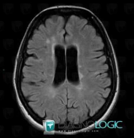 Multiple sclerosis, Ventricles / Periventricular region, MRI