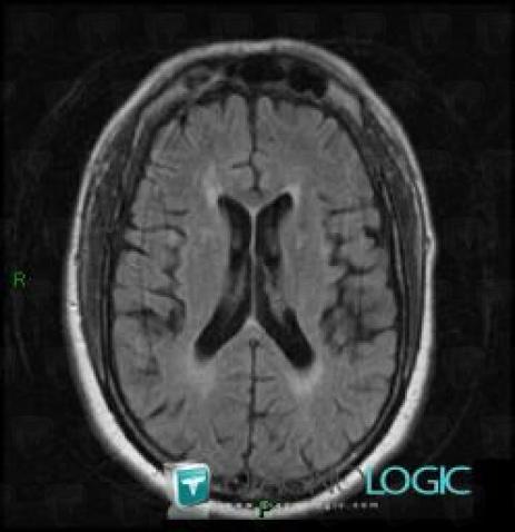 Multiple sclerosis, Ventricles / Periventricular region, MRI