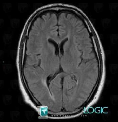 Multiple sclerosis, Ventricles / Periventricular region, MRI