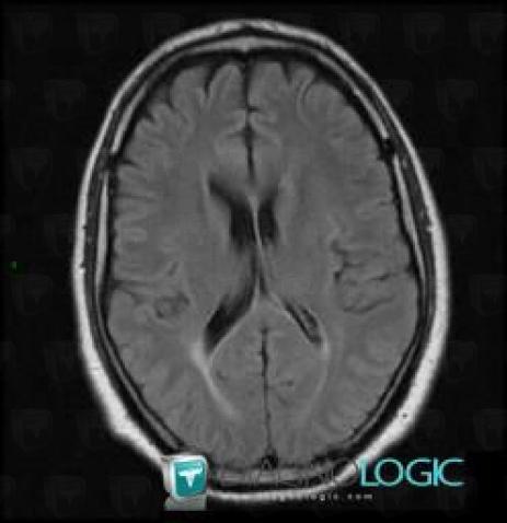 Radiology case : Multiple sclerosis (MRI) - Diagnologic