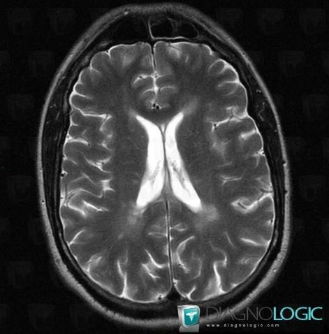 Multiple sclerosis, Ventricles / Periventricular region, MRI