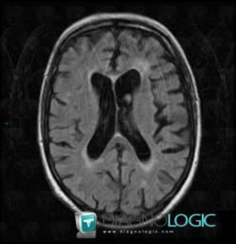 Multiple sclerosis, Ventricles / Periventricular region, MRI