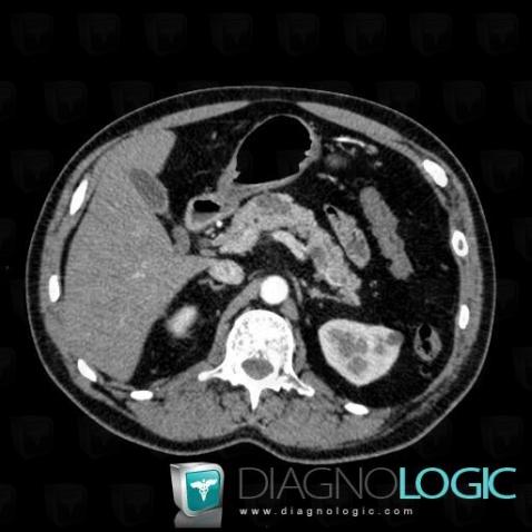 Multiple true cysts, Pancreas, CT