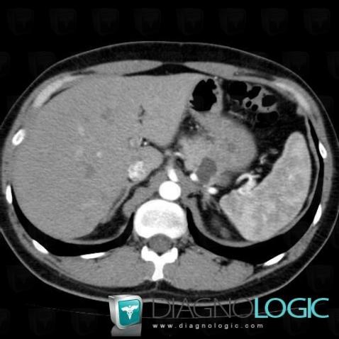 Multiple true cysts, Pancreas, CT