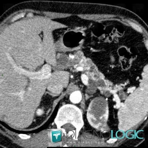 Multiple true cysts, Pancreas, CT