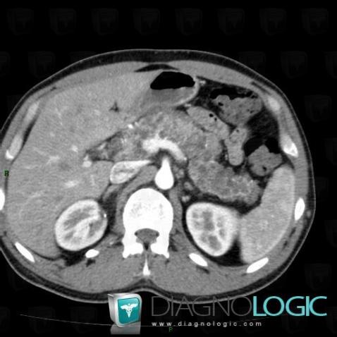 Multiple true cysts, Pancreas, CT