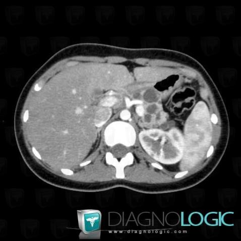 Multiple true cysts, Pancreas, CT