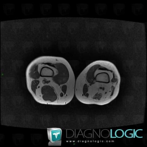 Muscle fatty infiltration, Muscles - Thigh, MRI