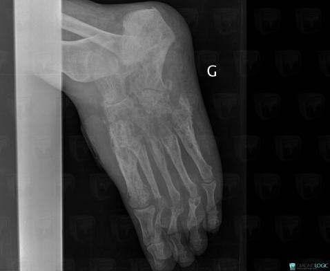 Mycetoma, Calcaneus, Cuboid, X rays