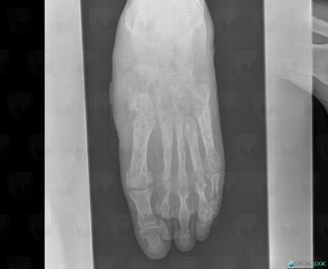 Mycetoma, Cuboid, Cuneiforms bones, X rays