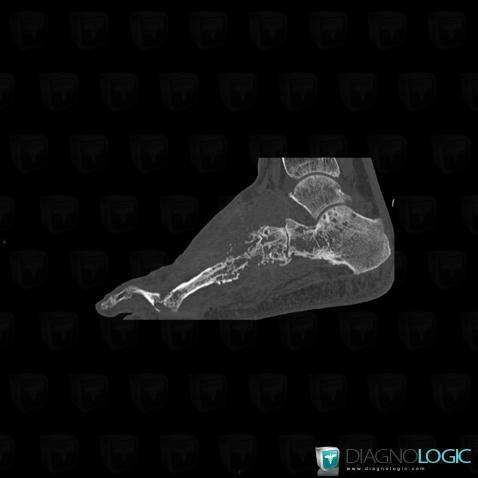 Mycetoma, Metatarsal bones, CT