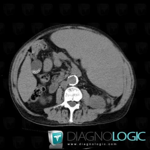 Myelofibrosis, Spleen, CT