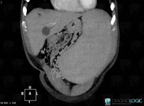 Myelofibrosis, Spleen, CT