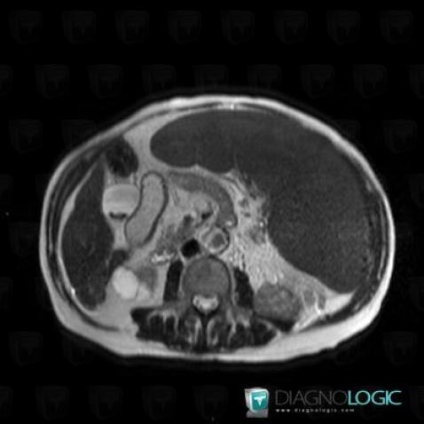 Myelofibrosis, Spleen, MRI