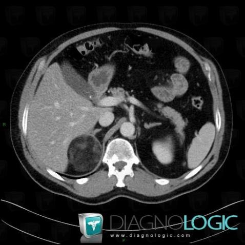 Myelolipoma, Adrenal glands, CT