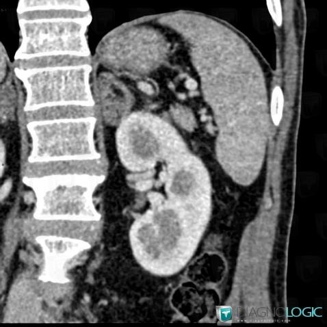 Myelolipoma, Adrenal glands, CT