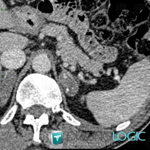 Myelolipoma, Adrenal glands, CT