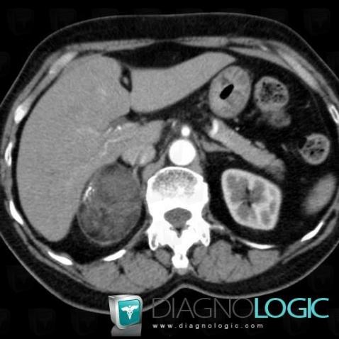 Myelolipoma, Adrenal glands, CT