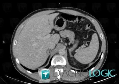 Myelolipoma, Adrenal glands, CT